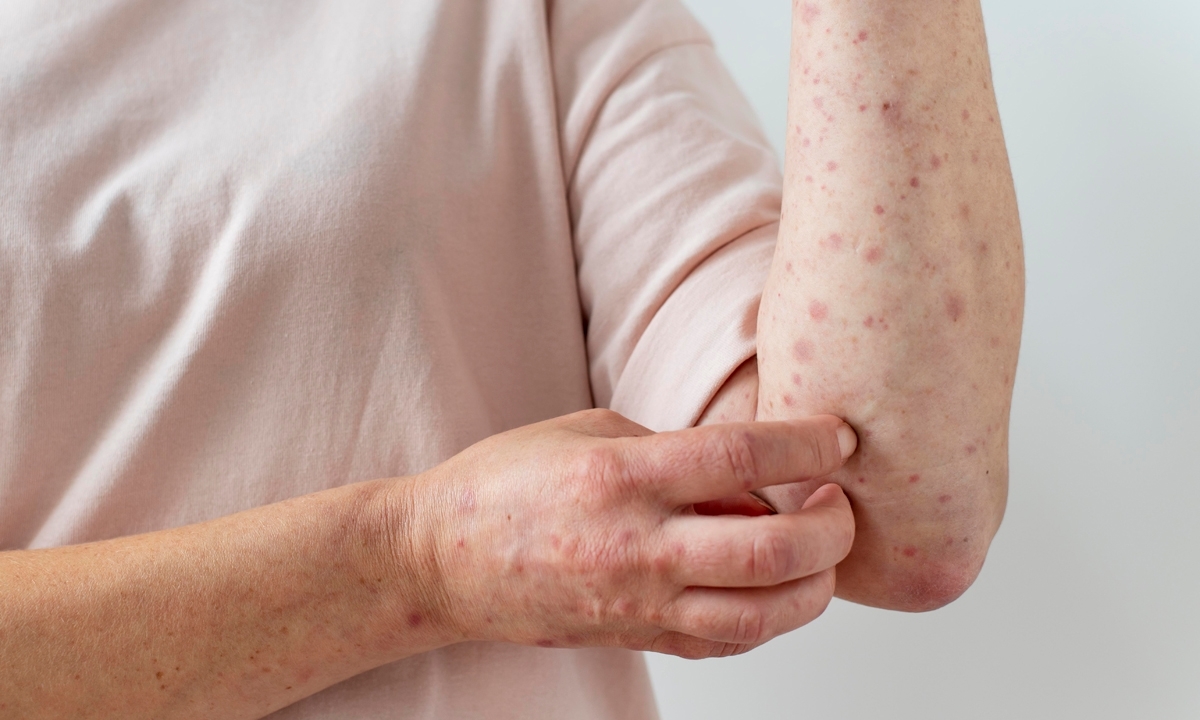 Grande ABC registra seis casos de mpox em 2026