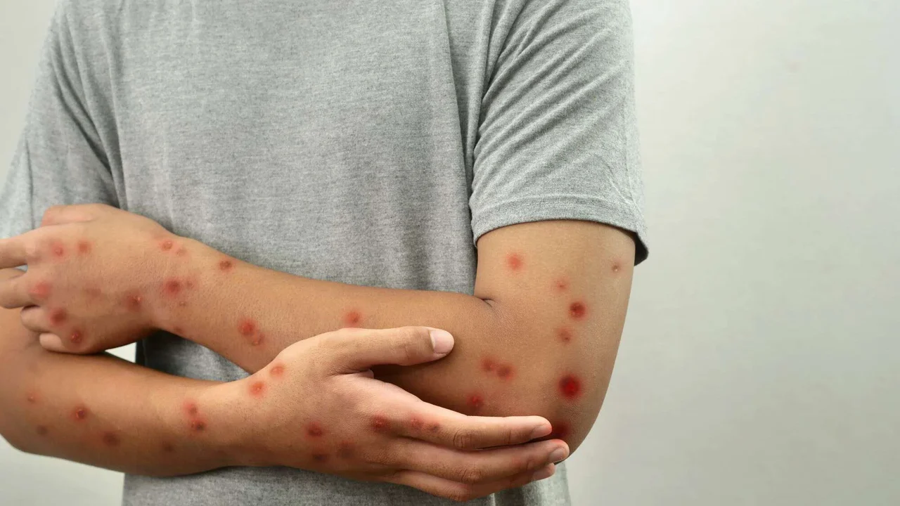 Rio de Janeiro registra alta de casos de Mpox e falta de vacinas
