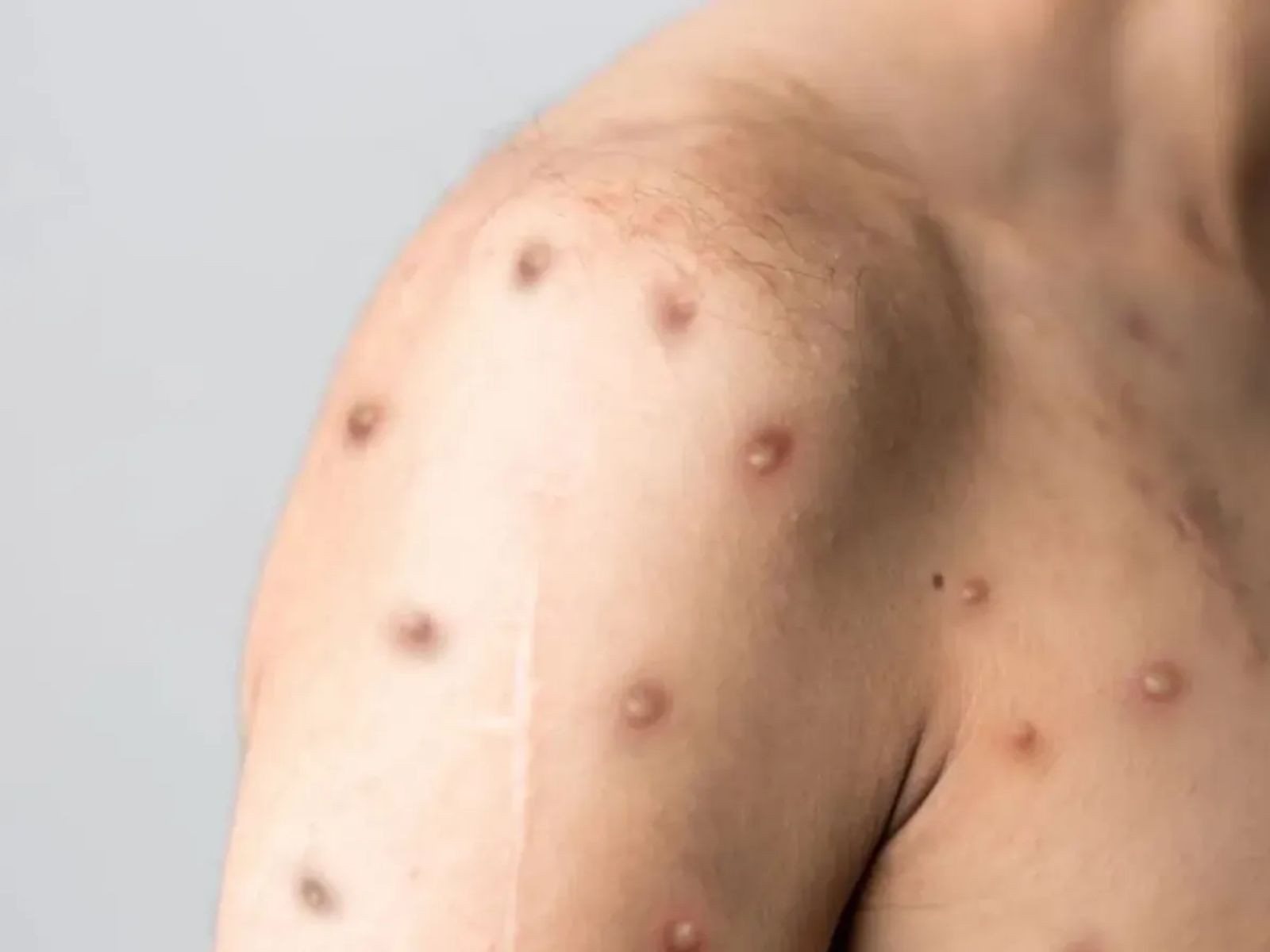 Casos de mpox sobem no Rio de Janeiro e cidade está sem vacinas