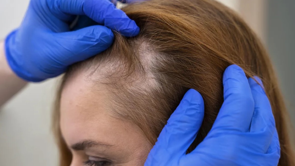 Especialistas alertam para os riscos do uso indiscriminado de vitaminas contra queda de cabelo