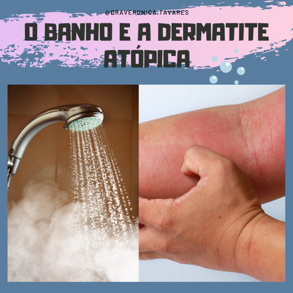 Estudos avaliam o uso de banhos diluídos de água sanitária na dermatite atópica