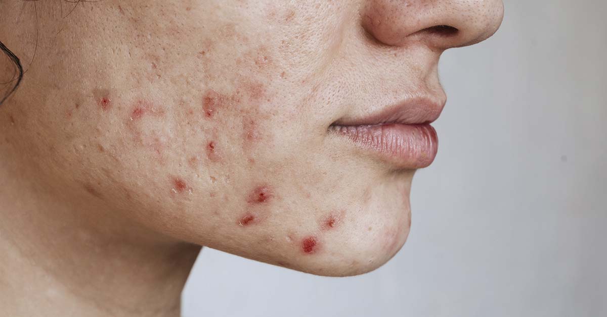 Entenda os tipos de acne e saiba como cuidar da pele corretamente