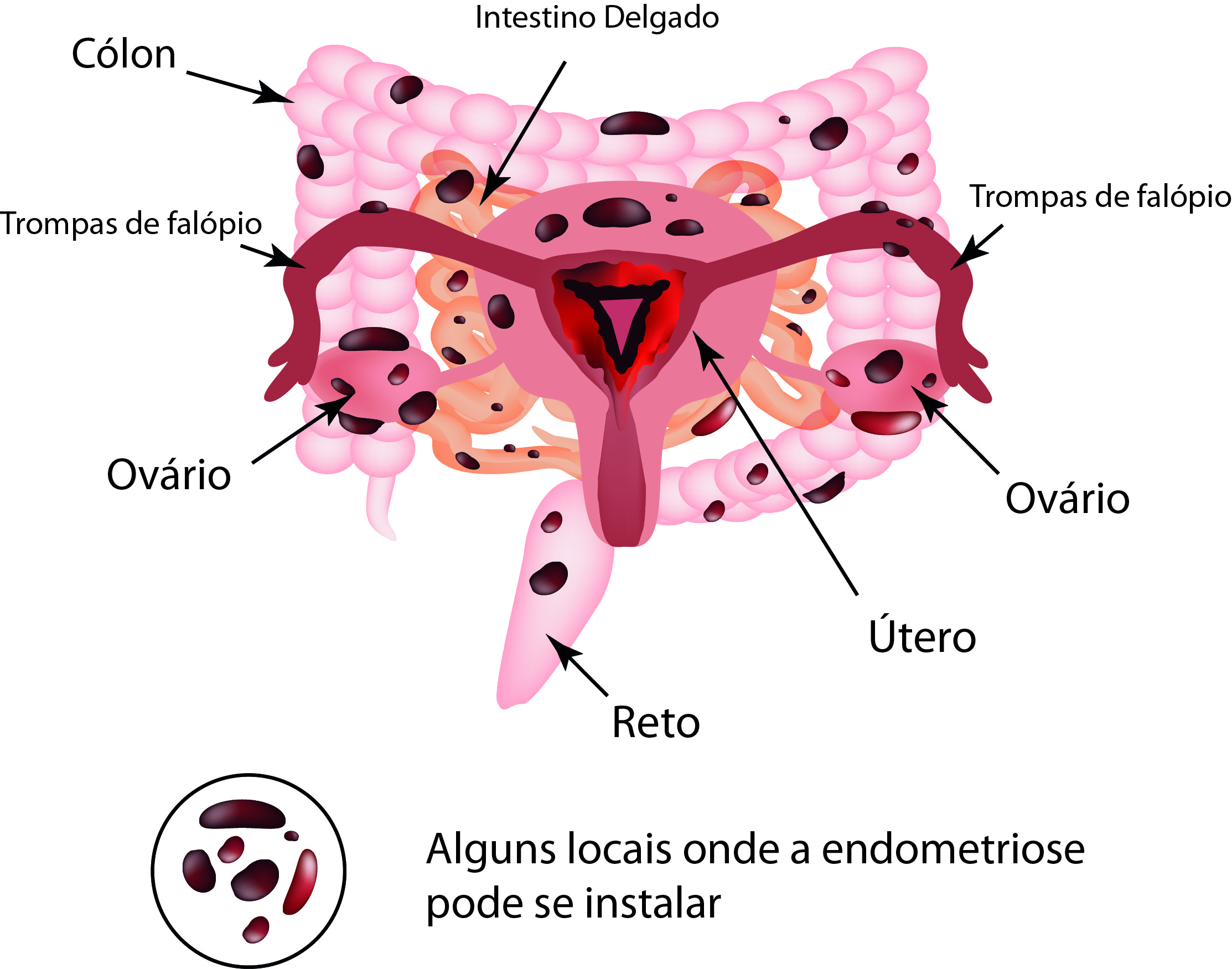 Consenso médico descarta restrições sem evidência para endometriose