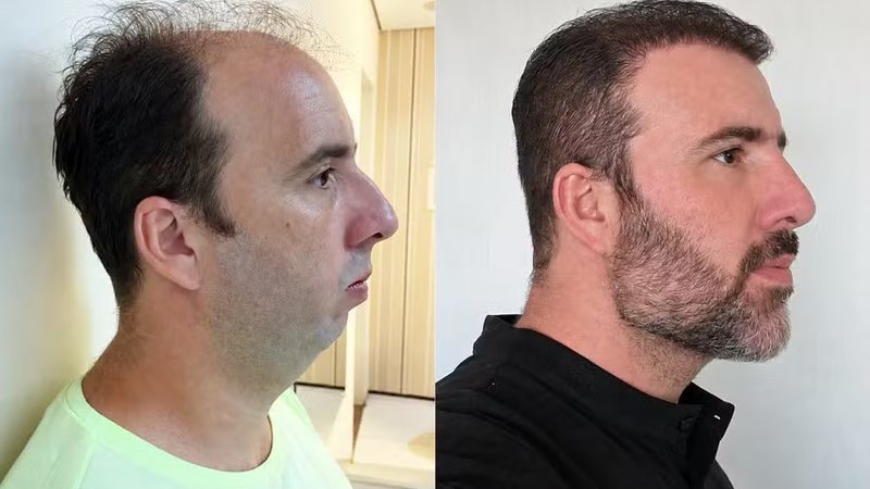 Engenheiro mecatrônico viraliza após passar por harmonização facial