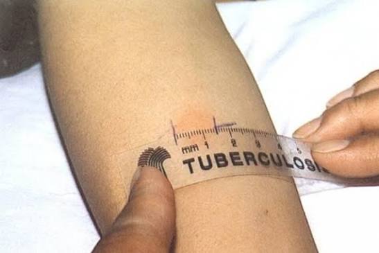 Cuiabá amplia oferta de teste para tuberculose na rede municipal